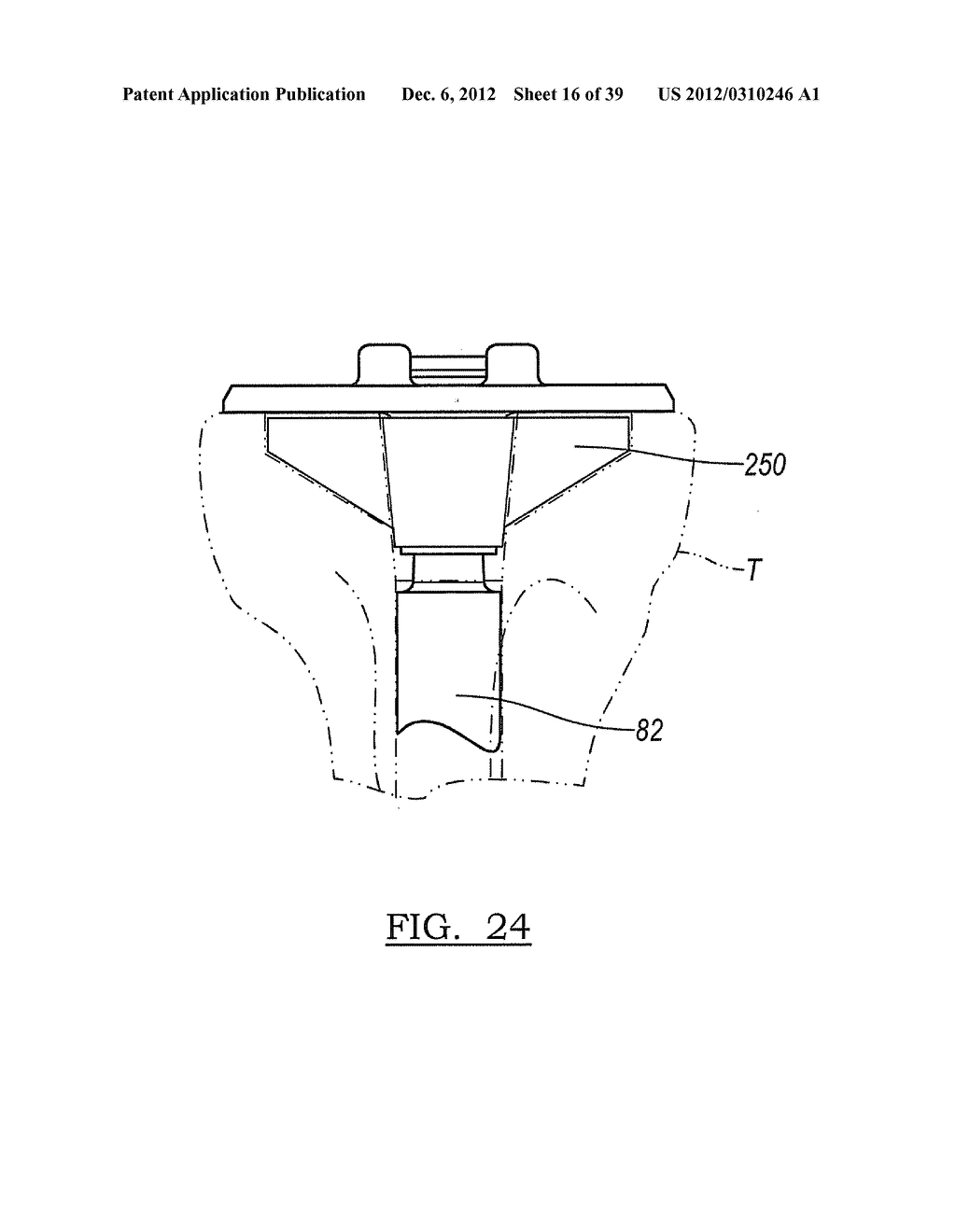 Method And Apparatus For Implanting A Knee Prosthesis - diagram, schematic, and image 17