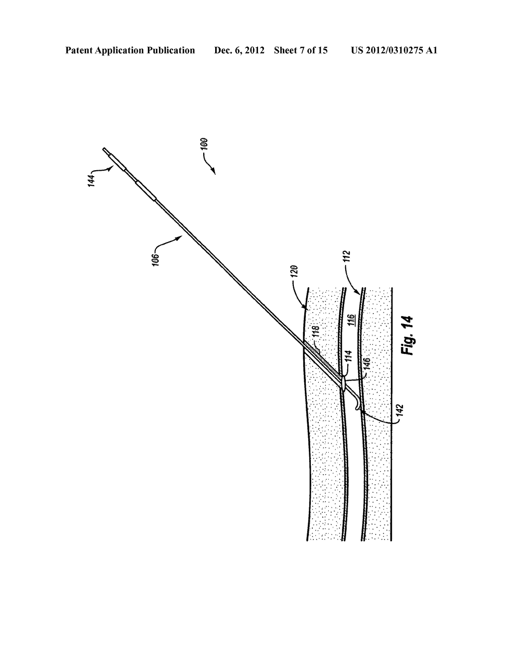 SINGLE PIECE, DUAL COMPONENT SEALING PAD AND METHODS - diagram, schematic, and image 08