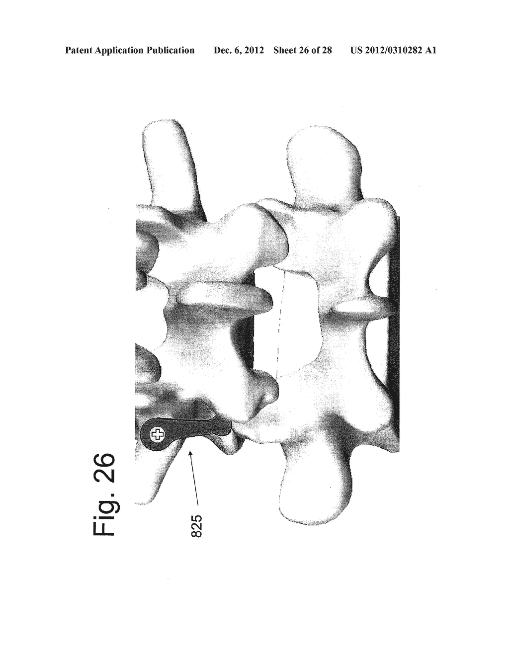 DEVICE AND METHOD FOR THE PREVENTION OF MULTI-LEVEL VERTEBRAL EXTENSION - diagram, schematic, and image 27