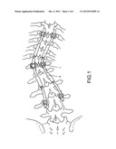 AUTOMATIC-EXTENDING AND ANTI-ROTATION SCOLIOSIS CORRECTING SYSTEM diagram and image