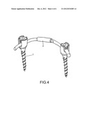 AUTOMATIC-EXTENDING AND ANTI-ROTATION SCOLIOSIS CORRECTING SYSTEM diagram and image