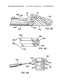 Artificial Disc Device diagram and image