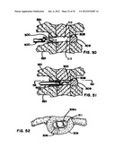 Artificial Disc Device diagram and image