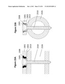 FLEXIBLE PLATE FIXATION OF BONE FRACTURES diagram and image