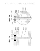 FLEXIBLE PLATE FIXATION OF BONE FRACTURES diagram and image