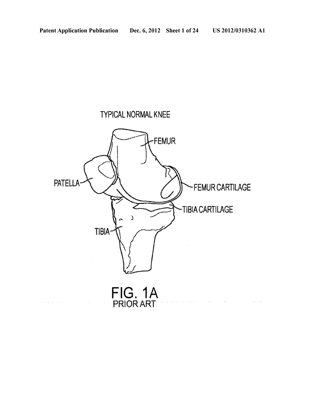 IMPLANT FOR RESTORING NORMAL RANGE FLEXION AND KINEMATICS OF THE KNEE - diagram, schematic, and image 02