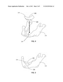 PATIENT-SPECIFIC MANUFACTURING OF POROUS METAL PROSTHESES diagram and image