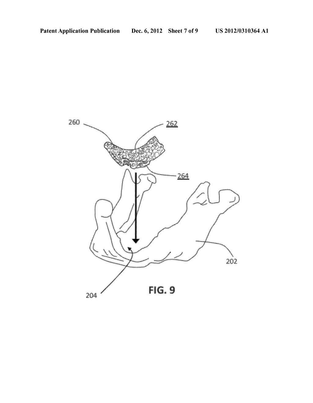 PATIENT-SPECIFIC MANUFACTURING OF POROUS METAL PROSTHESES - diagram, schematic, and image 08