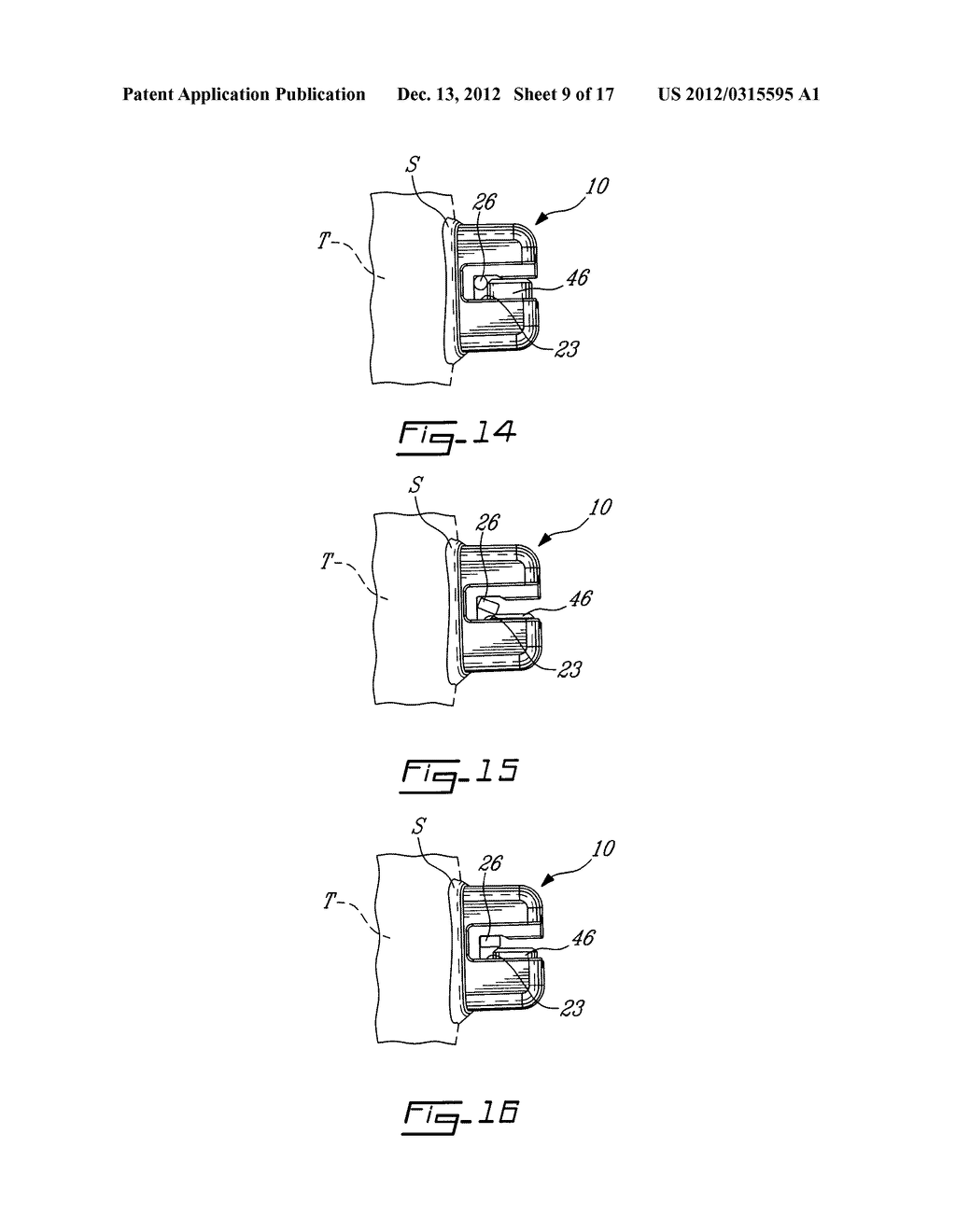 BRACKET WITH FRONT OPENING AND ORTHODONTIC INTER-BRACKET ADJOINING     MECHANISM - diagram, schematic, and image 10