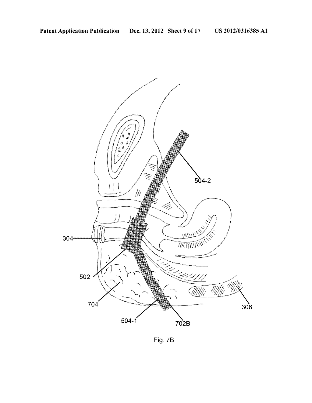 BODILY IMPLANTS AND METHODS OF TREATING FECAL INCONTINENCE USING BODILY     IMPLANTS - diagram, schematic, and image 10