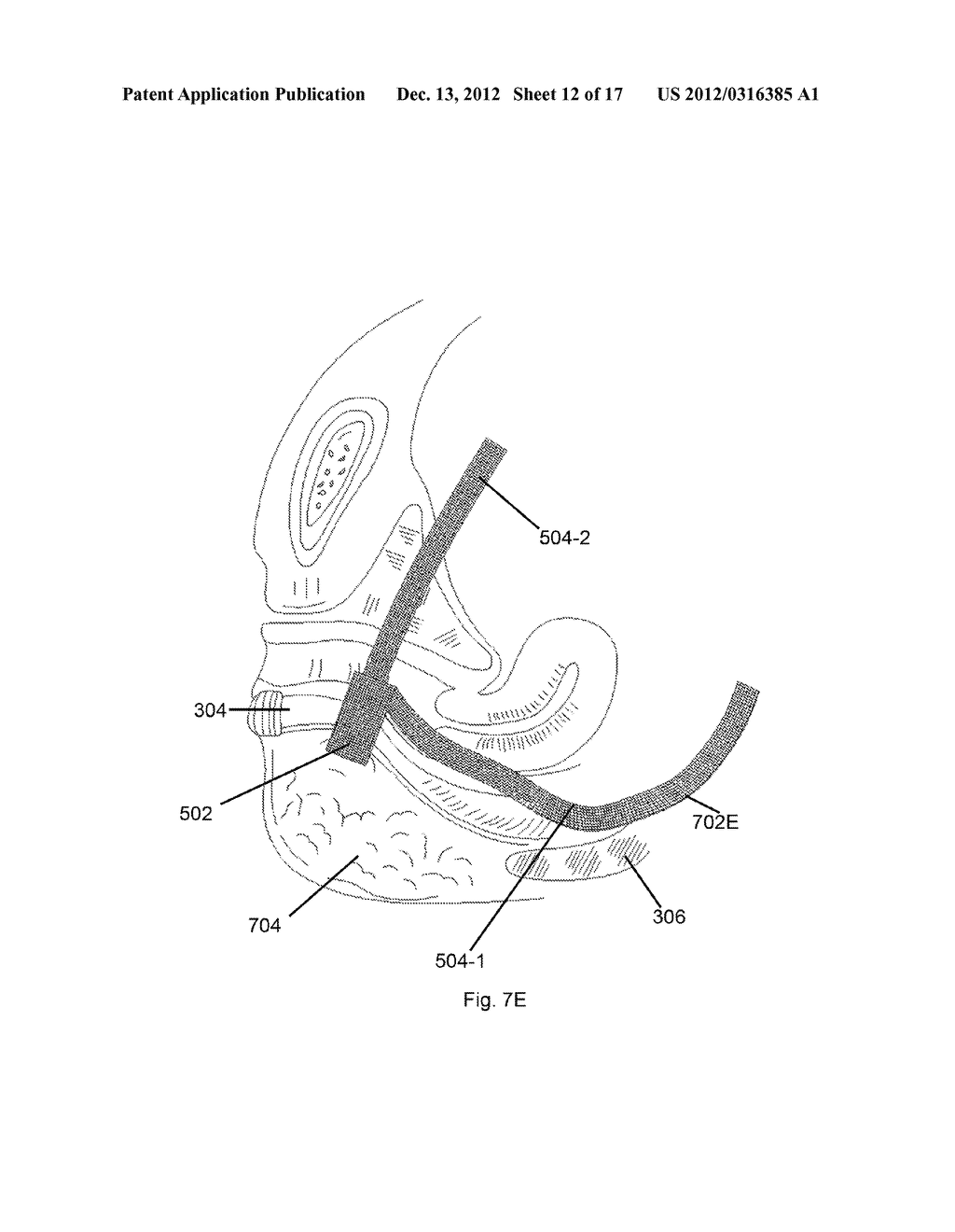 BODILY IMPLANTS AND METHODS OF TREATING FECAL INCONTINENCE USING BODILY     IMPLANTS - diagram, schematic, and image 13