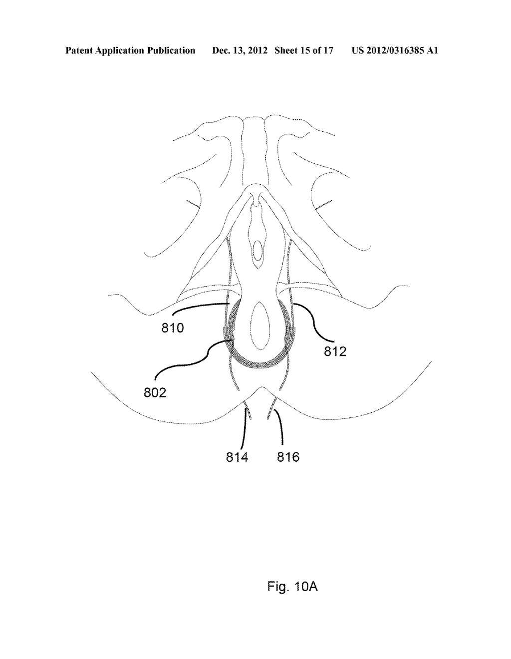 BODILY IMPLANTS AND METHODS OF TREATING FECAL INCONTINENCE USING BODILY     IMPLANTS - diagram, schematic, and image 16