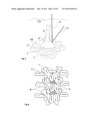 SURGICAL ACCESS DEVICE diagram and image