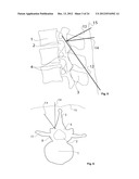 SURGICAL ACCESS DEVICE diagram and image