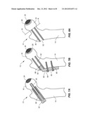 SUBCHONDRAL TREATMENT OF OSTEOARTHRITIS IN JOINTS diagram and image