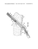 ARTICULATING SUTURING DEVICE AND METHOD diagram and image