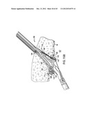 ARTICULATING SUTURING DEVICE AND METHOD diagram and image