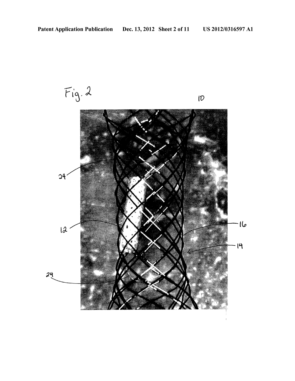 Device For Occluding A Lumen - diagram, schematic, and image 03