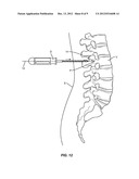 FLEXIBLE GUIDE WIRE diagram and image