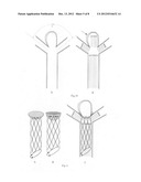 Retrievable covered stent for bifurcation aneurysms diagram and image