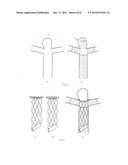 Retrievable covered stent for bifurcation aneurysms diagram and image