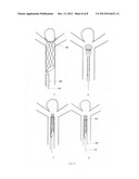 Retrievable covered stent for bifurcation aneurysms diagram and image