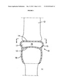 RESILIENT MEDICALLY INFLATABLE INTERPOSITIONAL ARTHROPLASTY DEVICE diagram and image