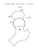 RESILIENT MEDICALLY INFLATABLE INTERPOSITIONAL ARTHROPLASTY DEVICE diagram and image