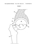 RESILIENT MEDICALLY INFLATABLE INTERPOSITIONAL ARTHROPLASTY DEVICE diagram and image