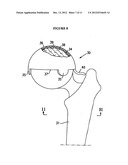 RESILIENT MEDICALLY INFLATABLE INTERPOSITIONAL ARTHROPLASTY DEVICE diagram and image