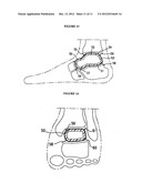 RESILIENT MEDICALLY INFLATABLE INTERPOSITIONAL ARTHROPLASTY DEVICE diagram and image