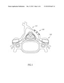 DEVICE FOR EXPANDABLE SPINAL LAMINOPLASTY diagram and image