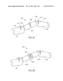 DEVICE FOR EXPANDABLE SPINAL LAMINOPLASTY diagram and image