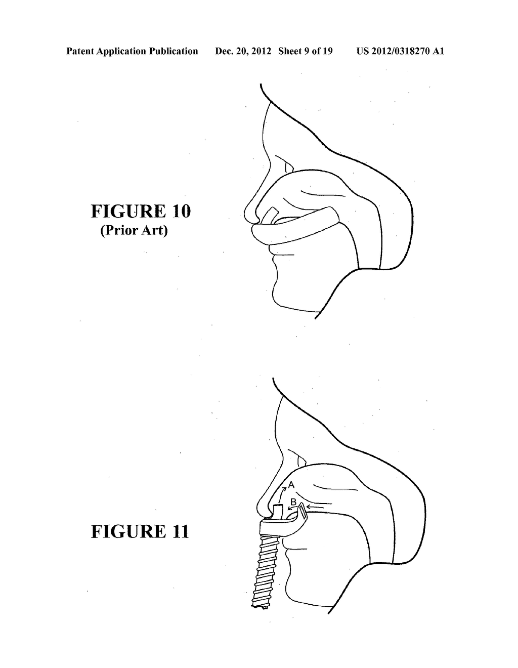 NASAL INTERFACE - diagram, schematic, and image 10