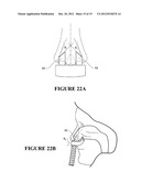 NASAL INTERFACE diagram and image