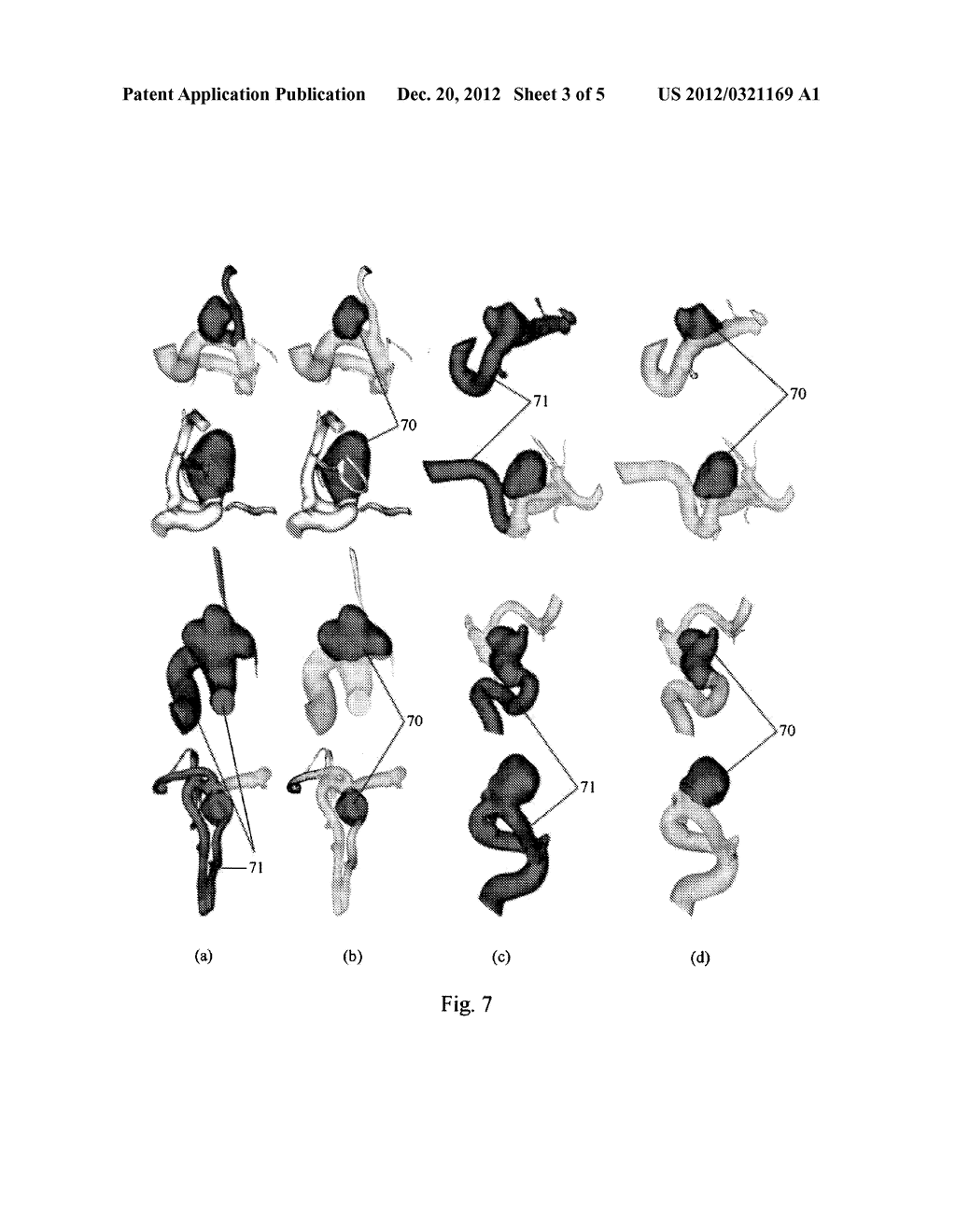 Shape Based Conditional Random Fields for Segmenting Intracranial     Aneurysms - diagram, schematic, and image 04