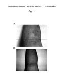 THERAPEUTIC AGENT FOR USE IN A METHOD OF TREATING PSORIASIS OR ATOPIC     DERMATITIS diagram and image