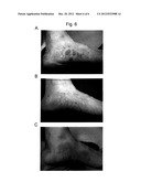 THERAPEUTIC AGENT FOR USE IN A METHOD OF TREATING PSORIASIS OR ATOPIC     DERMATITIS diagram and image