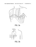 IDENTIFICATION OF CULPRIT CORONARY ARTERY USING ANATOMICALLY ORIENTED ECG     DATA FROM EXTENDED LEAD SET diagram and image