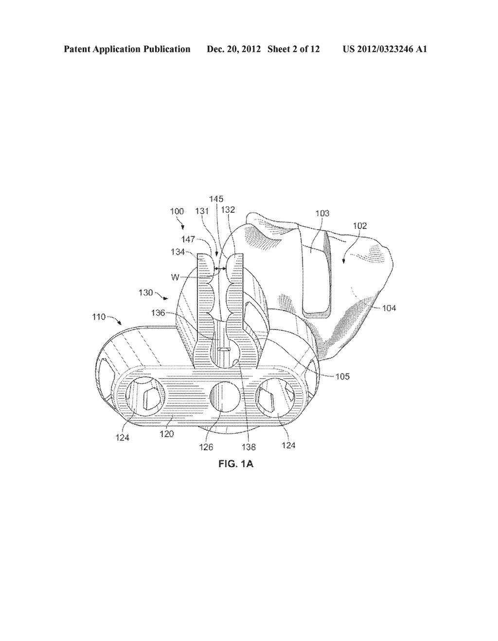 Patient-Specific Partial Knee Guides And Other Instruments - diagram, schematic, and image 03