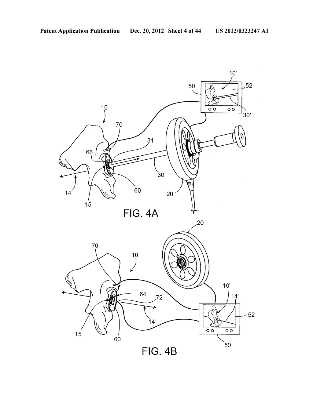 SURGICAL ALIGNMENT USING REFERENCES - diagram, schematic, and image 05