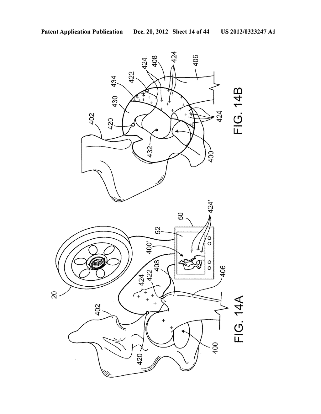 SURGICAL ALIGNMENT USING REFERENCES - diagram, schematic, and image 15