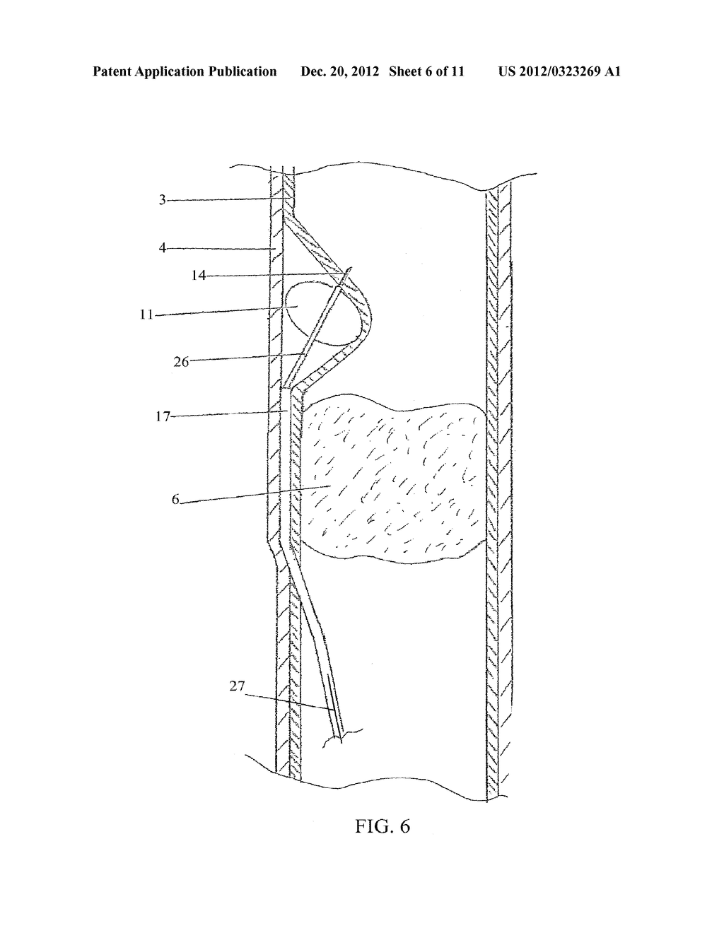 LUMEN REENTRY DEVICES AND METHODS - diagram, schematic, and image 07