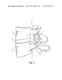 Spinal Facet Implants with Mating Articulating Bearing Surface and Methods     of Use diagram and image