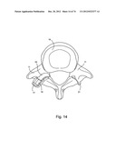 Spinal Facet Implants with Mating Articulating Bearing Surface and Methods     of Use diagram and image