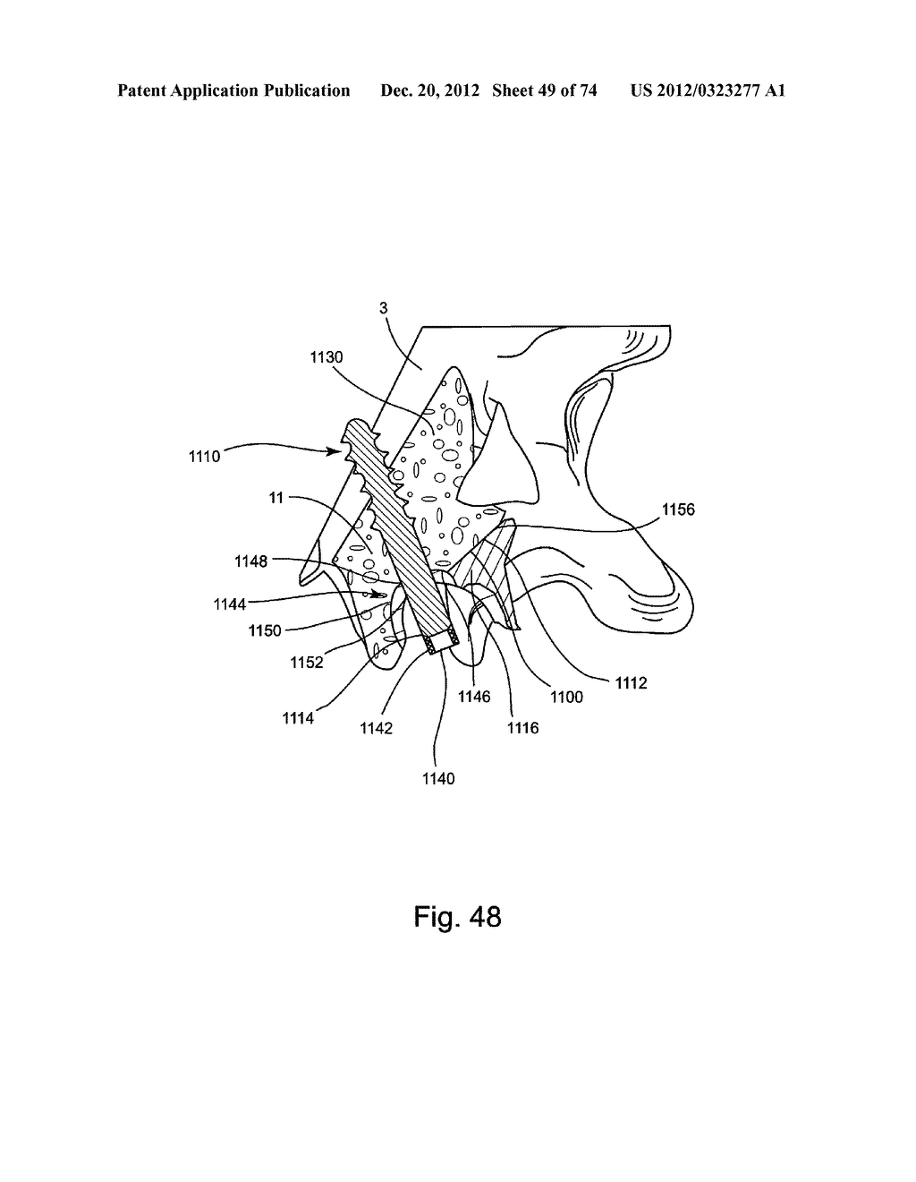 Spinal Facet Implants with Mating Articulating Bearing Surface and Methods     of Use - diagram, schematic, and image 50