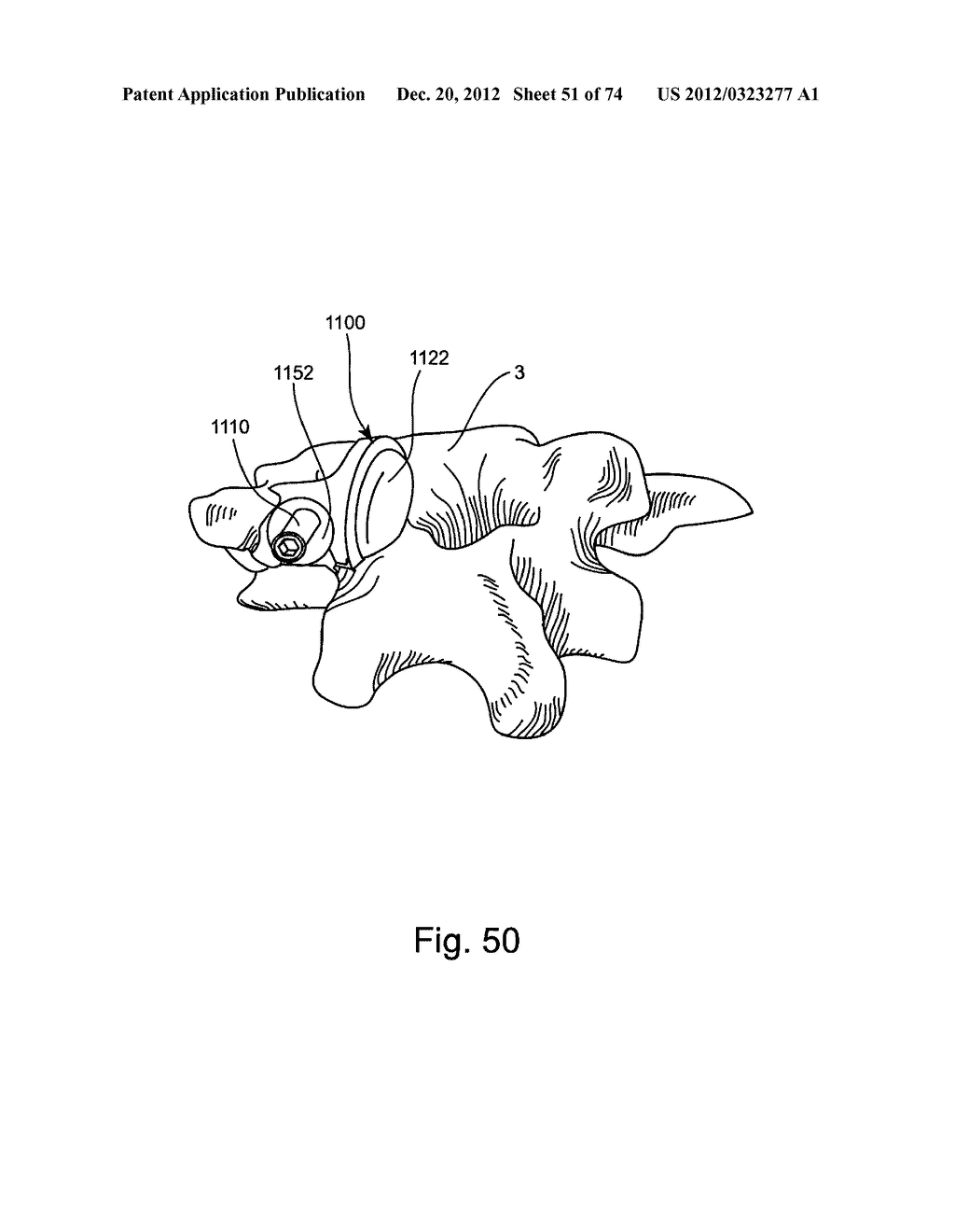 Spinal Facet Implants with Mating Articulating Bearing Surface and Methods     of Use - diagram, schematic, and image 52