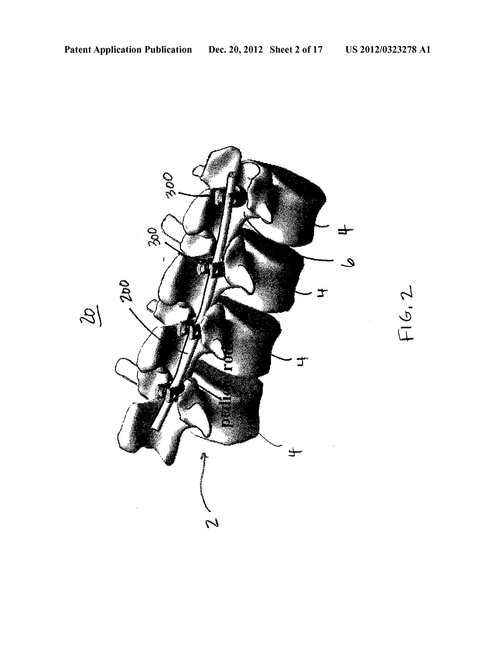 MINIMALLY INVASIVE SPINAL STABILIZATION SYSTEM - diagram, schematic, and image 03