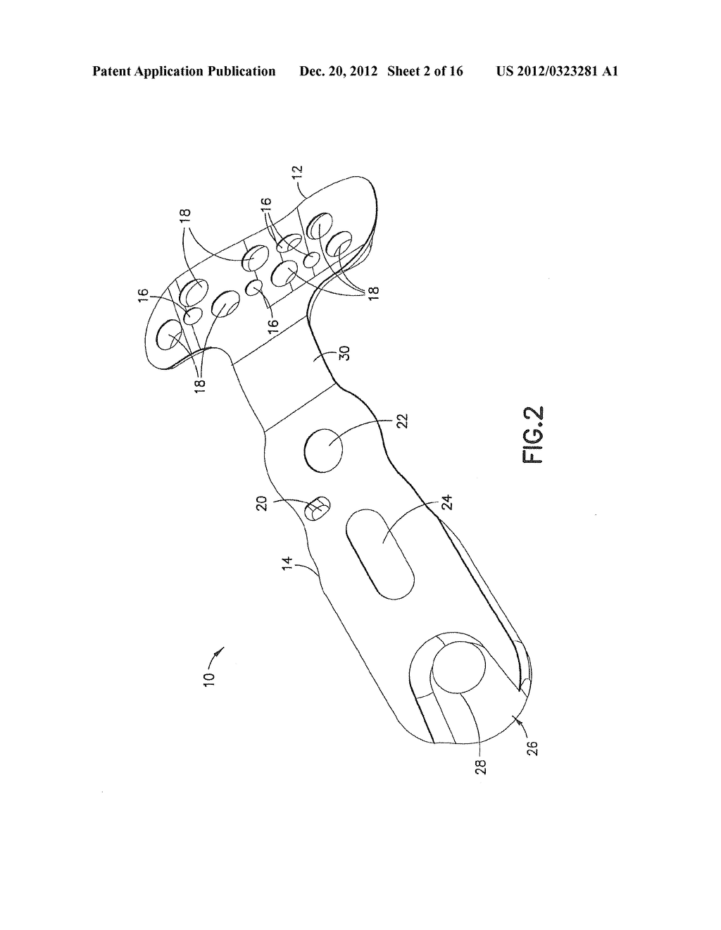 Method of Implanting a Modular Fracture Fixation System - diagram, schematic, and image 03