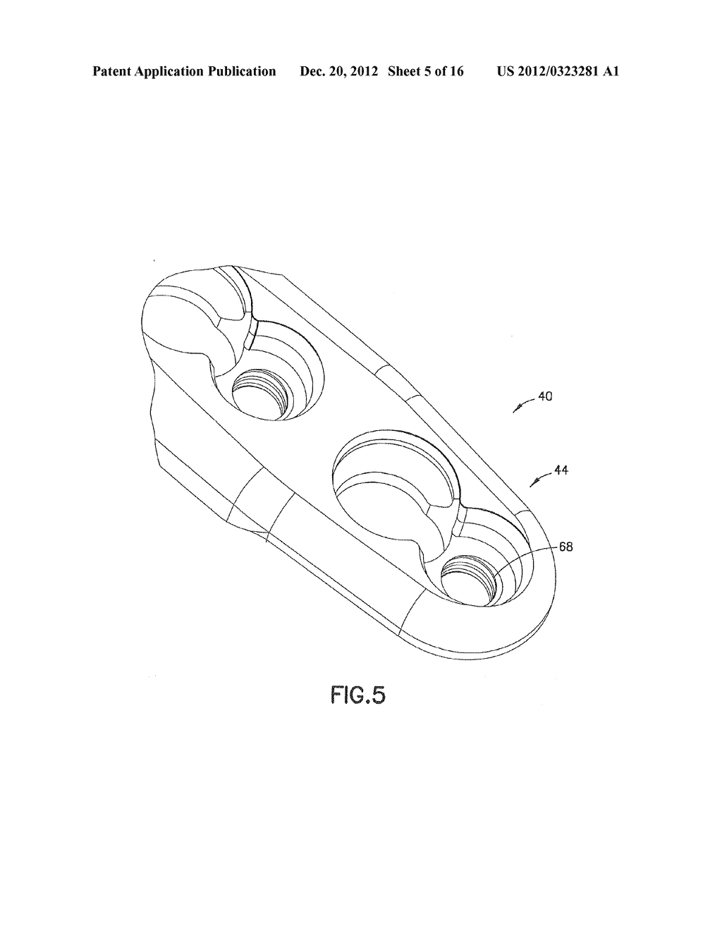 Method of Implanting a Modular Fracture Fixation System - diagram, schematic, and image 06